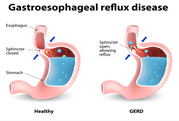 Heartburn and Gastroesophageal Reflux Disease